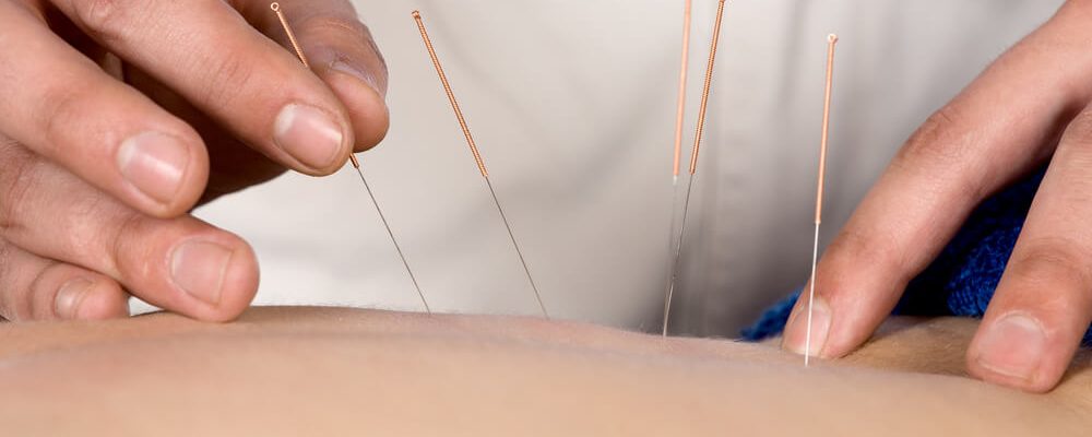 Acupuncture