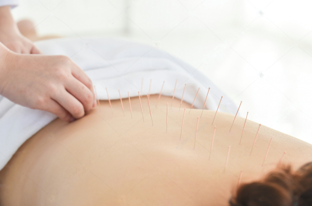 acupuncture